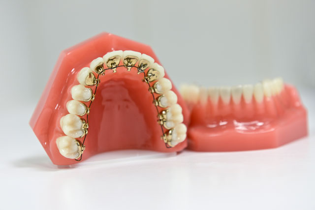 Lingual braces  Esthetic Orthodontic Treatment